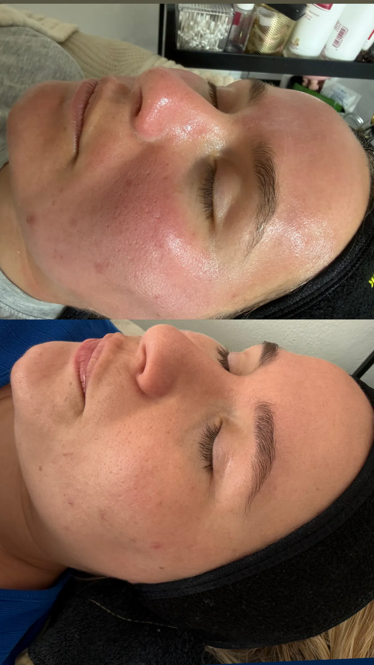 Før og efter ansigtsbehandling hos SB Cosmetics CPH