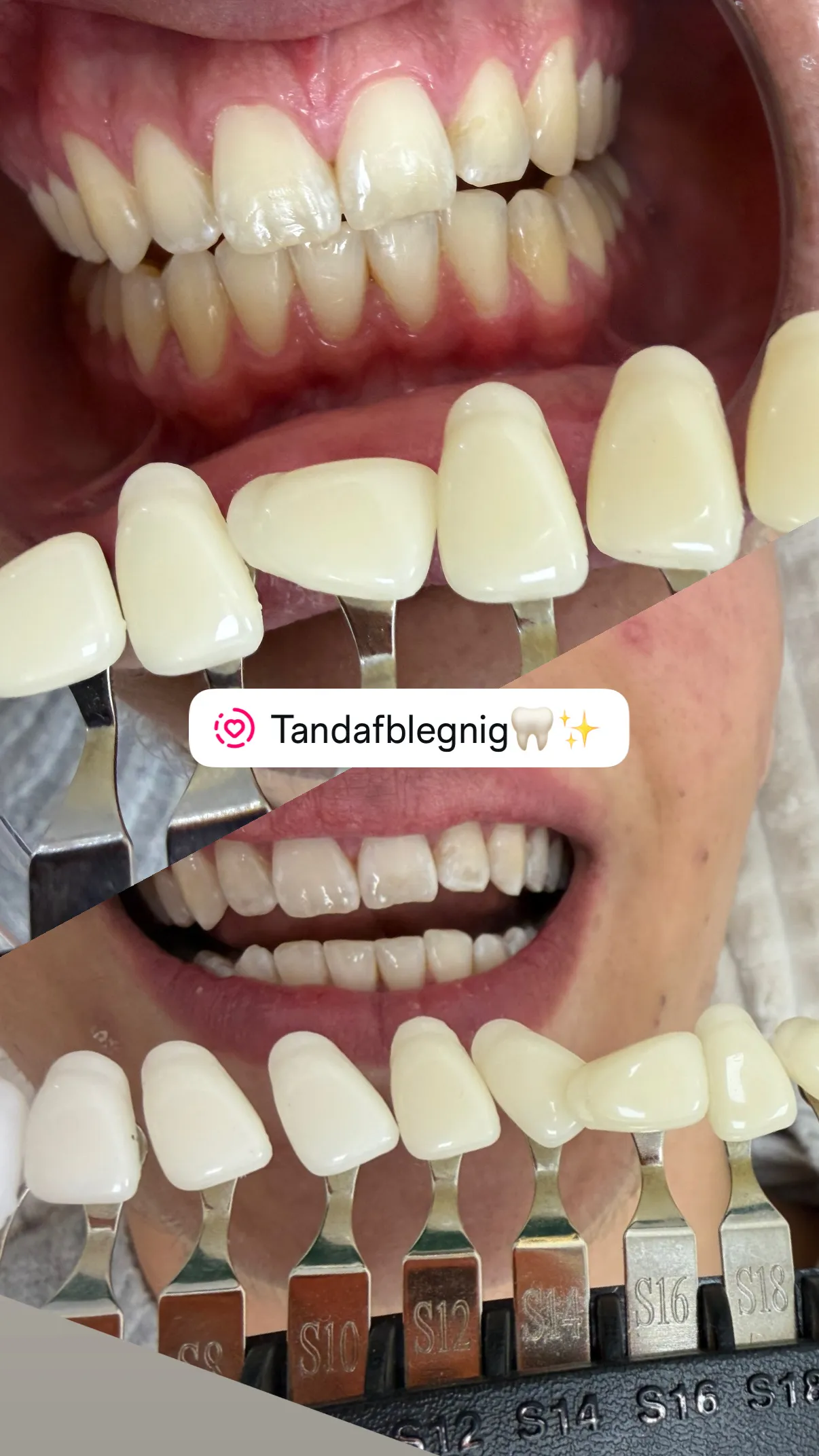 Før og efter kosmetisk tandblegning hos SB Cosmetics CPH