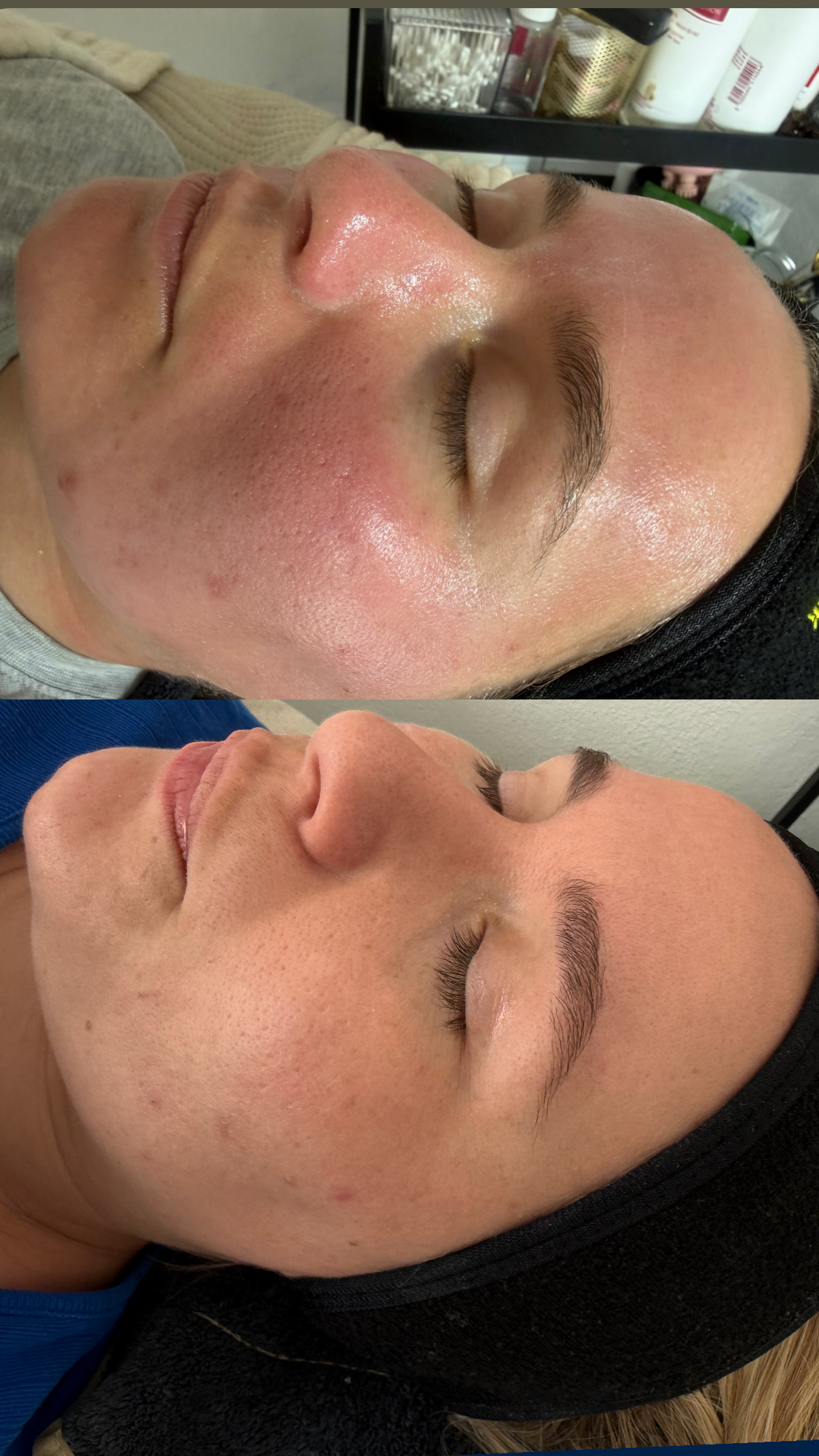 Microneedling Skinpen